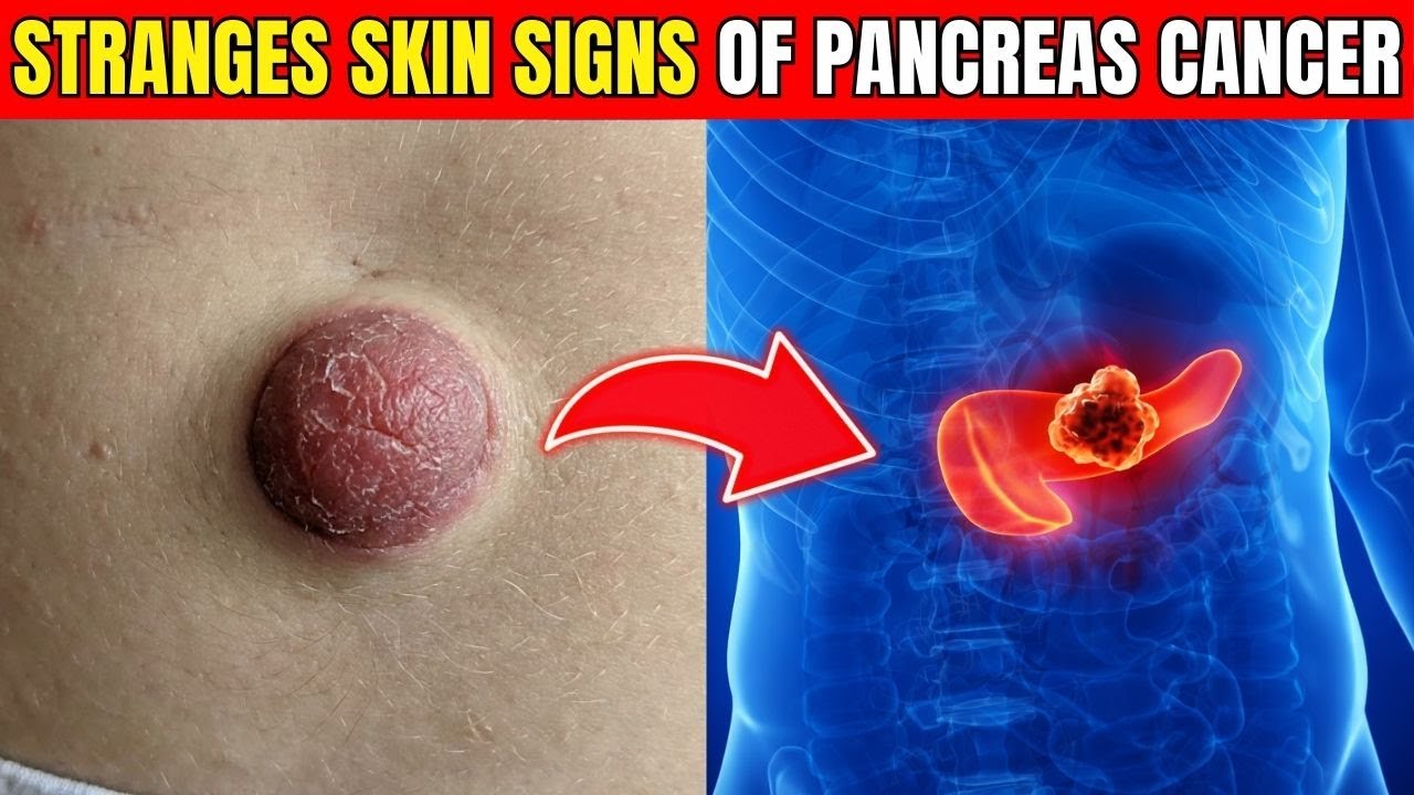 6 Skin Warning Signs of Pancreatic Cancer You Should Never Ignore| Healthy Care