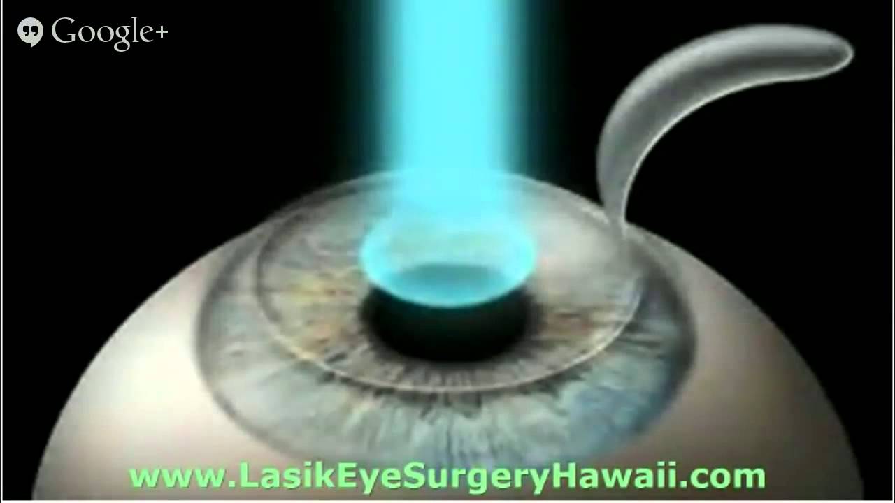 Best Lasik Eye Surgery Hawaii 8083774101 Call Now YouTube