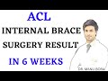 Acl internal brace surgery result in 6 weeks dr manu bora