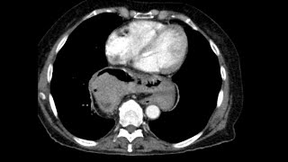 Gastric Adenocarcinoma @yaleradiology