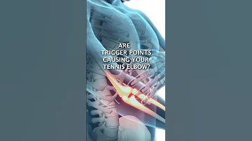 Are Trigger Points Causing Your Tennis Elbow?