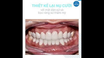 Thiết Kế Lại Nụ Cười Với Mặt Dán Sứ Và Bọc Răng Sứ Thẩm Mỹ.