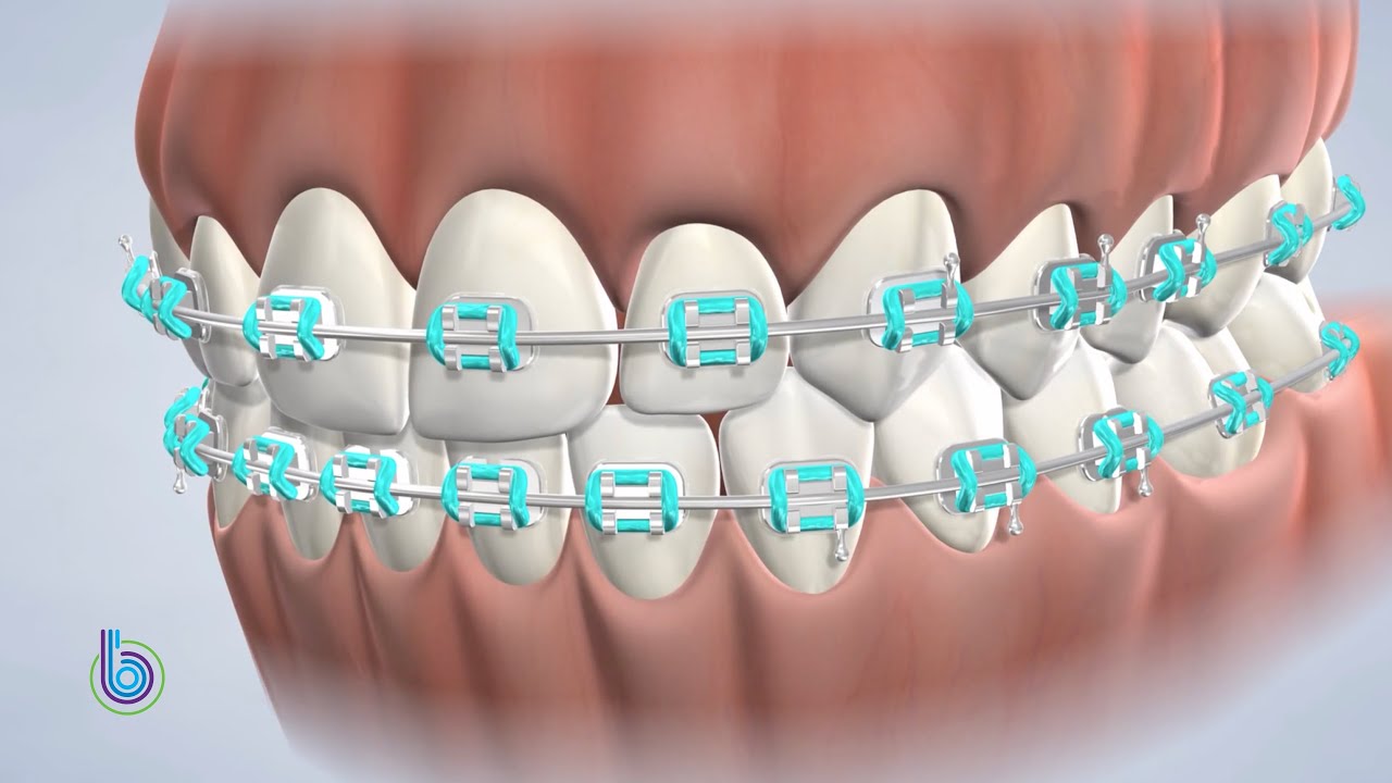 Rubber Bands Instructions  Braces Omaha - Orthodontics & Invisalign®