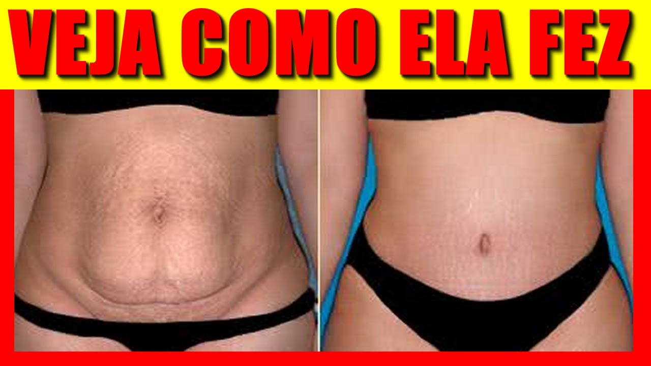 Como Acabar Com Estrias Na Barriga Depois Da Gravidez Tratamento 100 