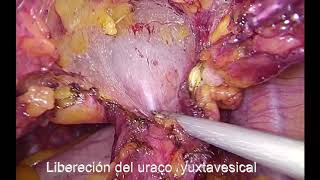 Quiste de uraco. Quistectomía por laparoscopia. Laparoscopic treatment Urachal cyst