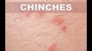 ¿Qué le ocurre a tu piel si tienes chinches?