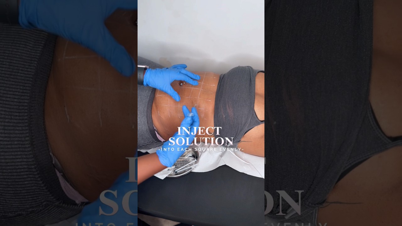 Powerful Promoitalia Fat Dissolving Italian Injections