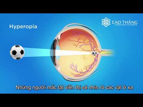 [Bệnh viện Mắt Cao Thắng] Viễn thị - Hyperopia