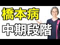 【橋本病 症状】中期段階は？！　（札幌 橋本病）