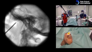 Dr Agnes Stogicza: RF E-Learning Seminar 3 Session 1: Gasser ganglion