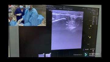Pre-emptive vs Postoperative Ultrasound-guided mandibular nerve block - Video abstract [ID 290462]