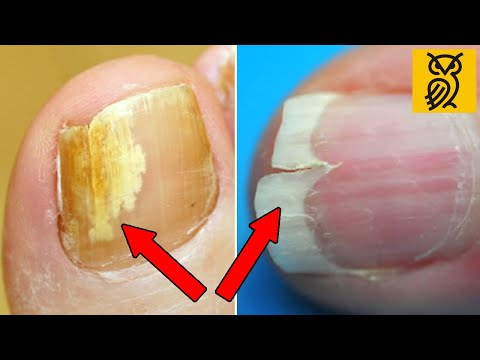Video: 3 cách điều trị móng chân bị rách
