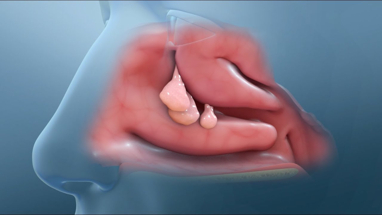 Rhinoplasty (Nose Job) Video Animation - Guncel Ozturk, MD - #DRGO