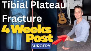 Tibial Plateau Fracture Rehab Weeks 4–6: What You Should Be Doing