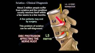 Sciatica causes, Clinical Diagnosis  and treatment.