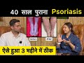 Psoriasis treatment in hindi ft  upasanakiduniya  skin disease  himanshu bhatt