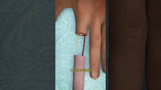 Kopmuş Bir Parmak Tekrar Takılabilir Mi