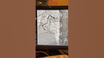 The support inflated-balloon technique. Complex CTO RCA, Antegrade approach.