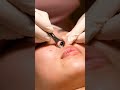 “Most Satisfying Blackhead Vacuum Extraction Ever! Real Deep Pore Cleaning ASMR for Stress Relief,