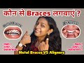 😰🦷Metal Braces VS Aligners ? || Pain, Cost ₹, Duration Full Comparison in Hindi | Miss Archu vlogs 
