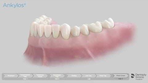 Animation of treatment steps with the Acuris conometric concept Ankylos