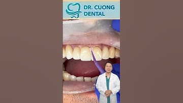 Lắp cầu răng sứ | Bác sĩ Cường #bacsicuong #shorts