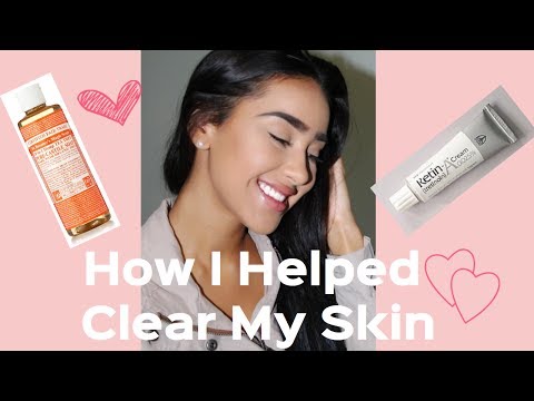 HOW I GOT RID OF MY (CYSTIC) ACNE | TIPS | REVIEW Dr. Bronners