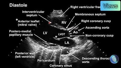 How to master parasternal long axis (PLAX) view in Echocardiography