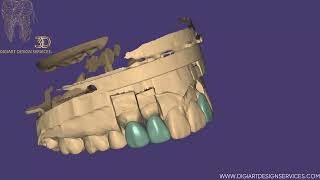 Exocad : Veneers Designing for Dental Lab