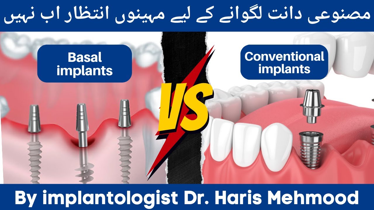 Comparison between Basal and Conventional Implants in Hindi/Urdu | which one is the better option?