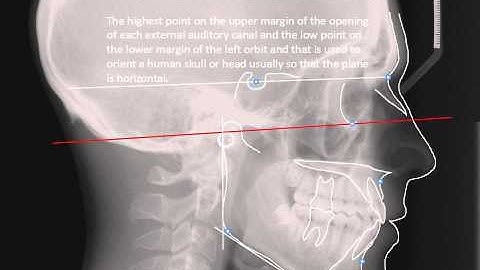 USC Undergraduate Orthodontics - Cephalometric Tracing