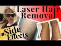 Side Effects Laser Hair Removal - TIPS & EDUCATION FROM AN AESTHETIC REGISTERED NURSE - Elina Y