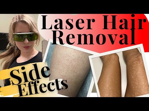 Video: Cara Merawat Kulit Setelah Laser Hair Removal: 9 Langkah