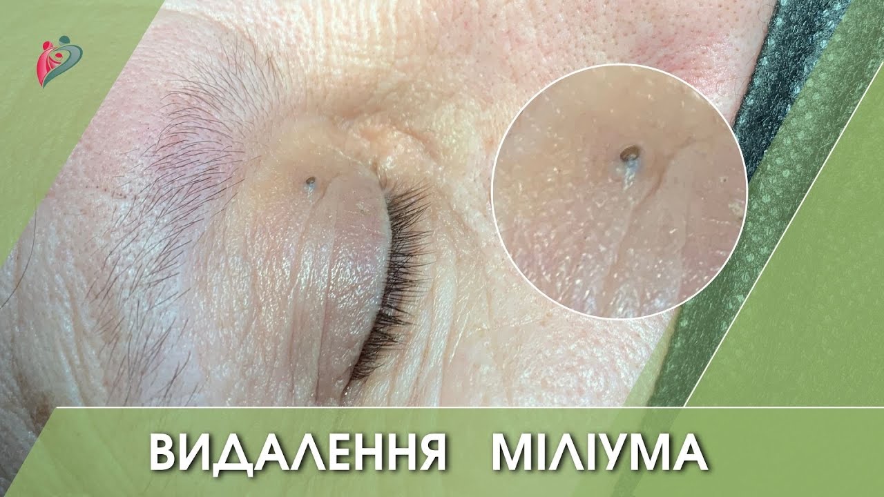 Милиумы что такое как избавиться