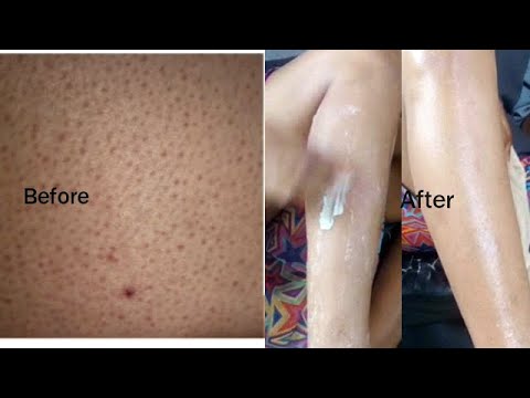 How to get rid of strawberry legs. - YouTube