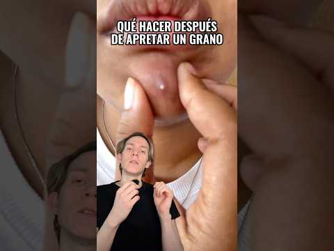 QUÉ HACER después de APRETAR UN GRANO #shorts