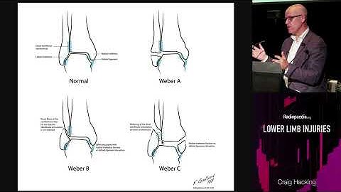 Weber enkelfracturen - Radiopaedia