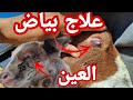 احسن علاج لبياض العين والنتيجة مضمونة مائة بالمائة احسن علاج لبياض العين والنتيجة مضمونة مائة بالمائة