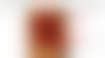 Patellar Tendon Reconstruction for a Chronic Extensor Mechanism Deficit ...