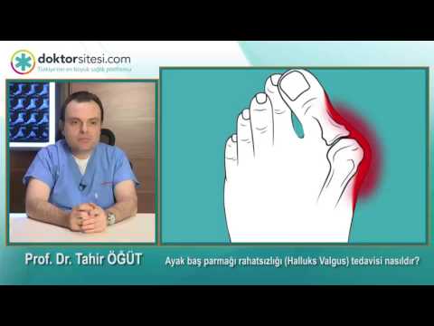 Ayak baş parmağı rahatsızlığı (Halluks Valgus) tedavisi nasıldır?