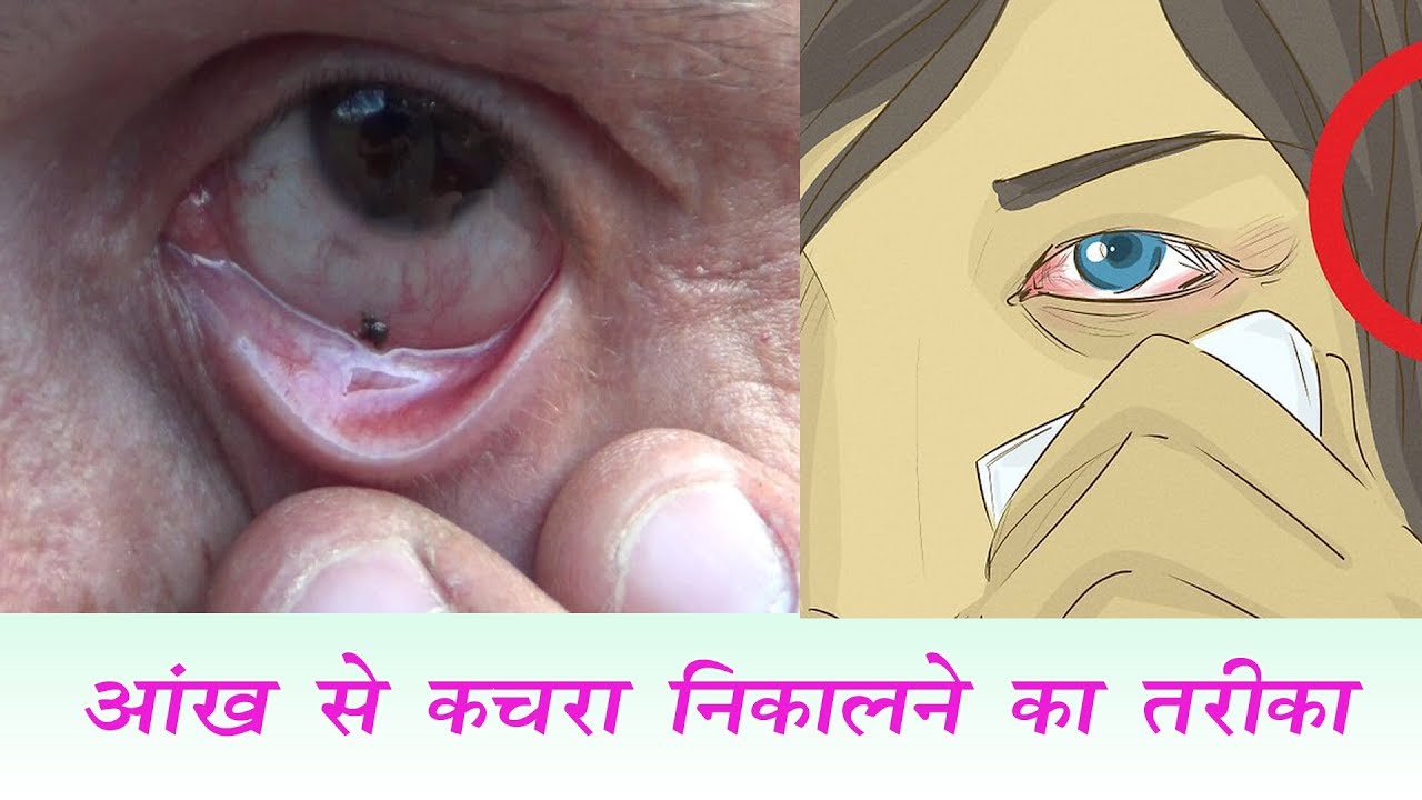 आँख से कचरा निकालने का तरीका Remove Dust Stone from Eye YouTube