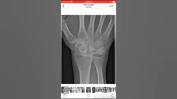 Case 065 Kienböck disease (avascular necrosis of the lunate).