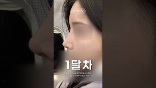 카리나st 복코교정+들창코교정 한달 차 후기✨ #shorts
