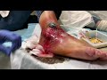 Large Ankle Infection in a diabetic patient - unedited complete video