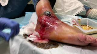 Large Ankle Infection in a diabetic patient - unedited complete video