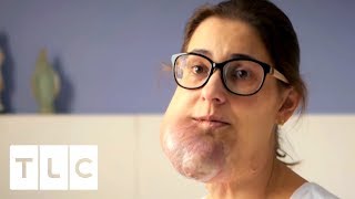Huge Face Tumour Started as a Birthmark | Body Bizarre