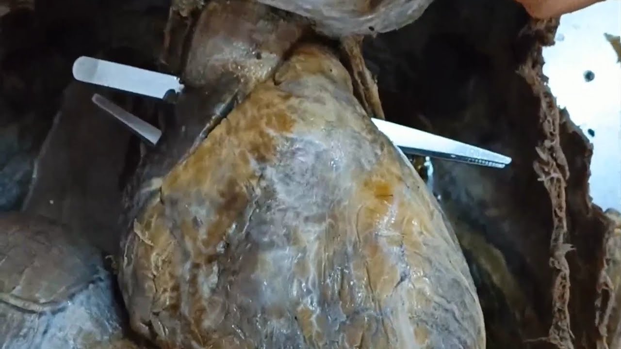 Sinuses of the Pericardium