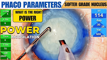 Phaco parameters modulation in soft grade cataract : Mature Intumescent cataract - Dr. Deepak Megur