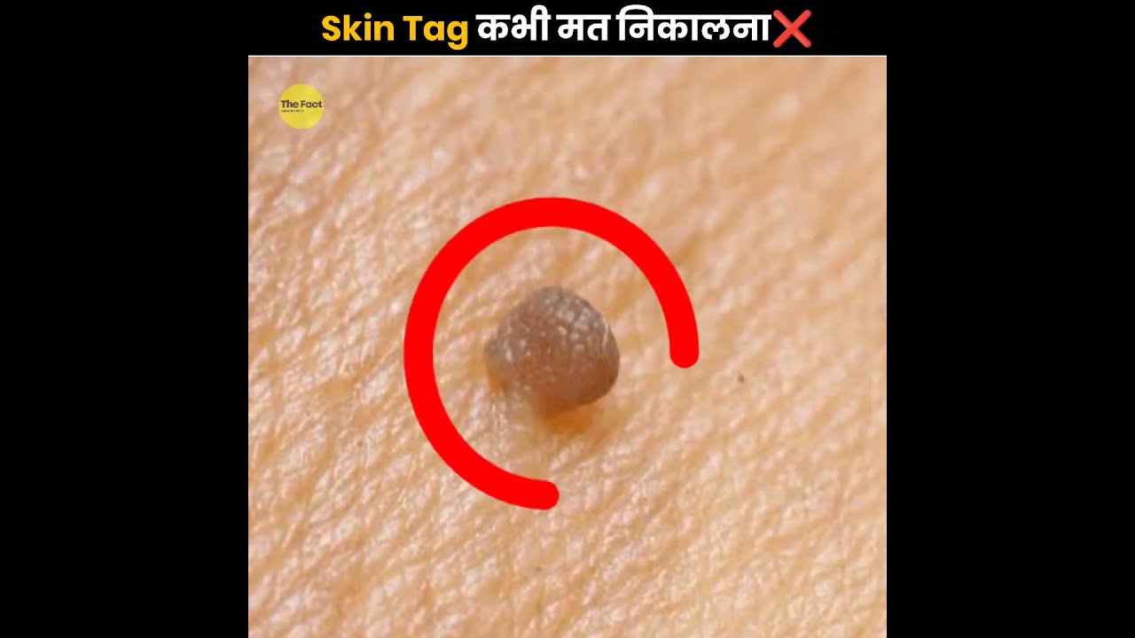 Skin Tag Never Remove The Fact Shorts Ytshorts