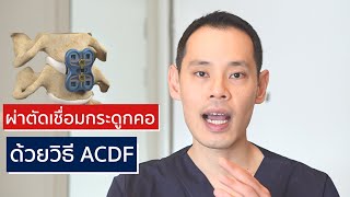 ผ่าตัดหมอนรองกระดูกคอทับเส้นประสาท ด้วยวิธีเชื่อมข้อกระดูกคอ ACDF | EasyDoc EP.40